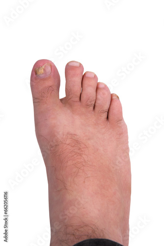 Nail fungus infection on big toe. Fungal infection on fingernails toe with ringworm onychomycosis, disease result