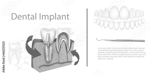 Dental implant structure medical pictorial educative infographic poster with molar replacement end healthy tools models vector illustration.