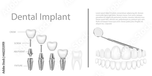 Dental implant structure medical pictorial educative infographic poster with molar replacement end healthy tools models vector illustration. photo