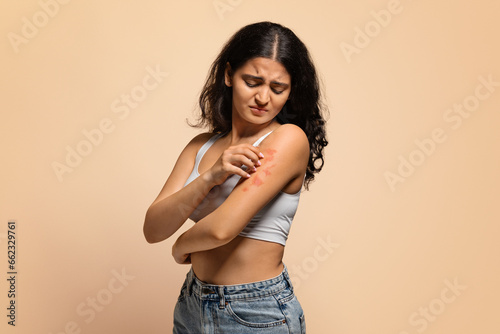 Dermatitis, eczema, allergy, psoriasis concept. Annoyed young indian woman scratching irritated skin