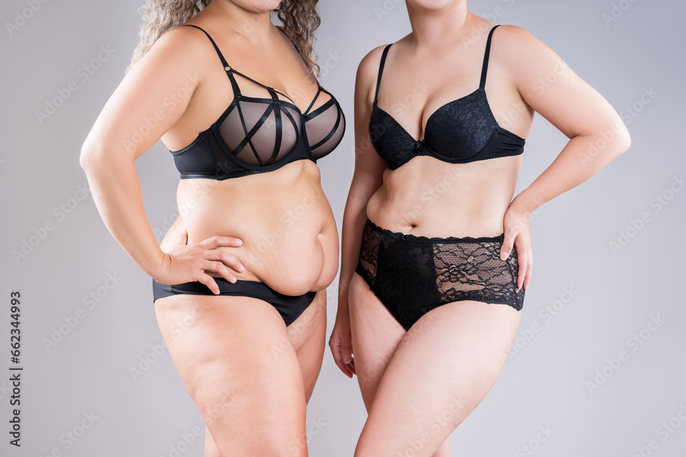 Tummy Tuck Two Fat Women With Flabby Bellies In Black Lingerie On Gray Background Plastic