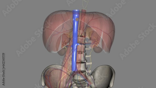 The inferior vena cava (IVC) is a large retroperitoneal vessel formed by the confluence of the right and left common iliac veins . photo