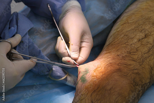 Medical surgery for endovenous laser photocoagulation of the great saphenous vein. Miniphlegectomy. Endovenous laser coagulation vein.