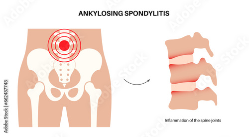 Ankylosing spondylitis disease