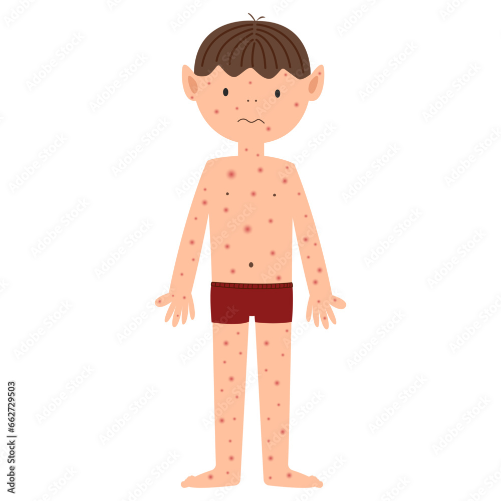Monkeypox Mpox disease with maculopapular rash symptom