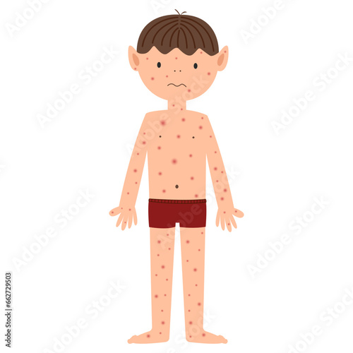 Monkeypox Mpox disease with maculopapular rash symptom
