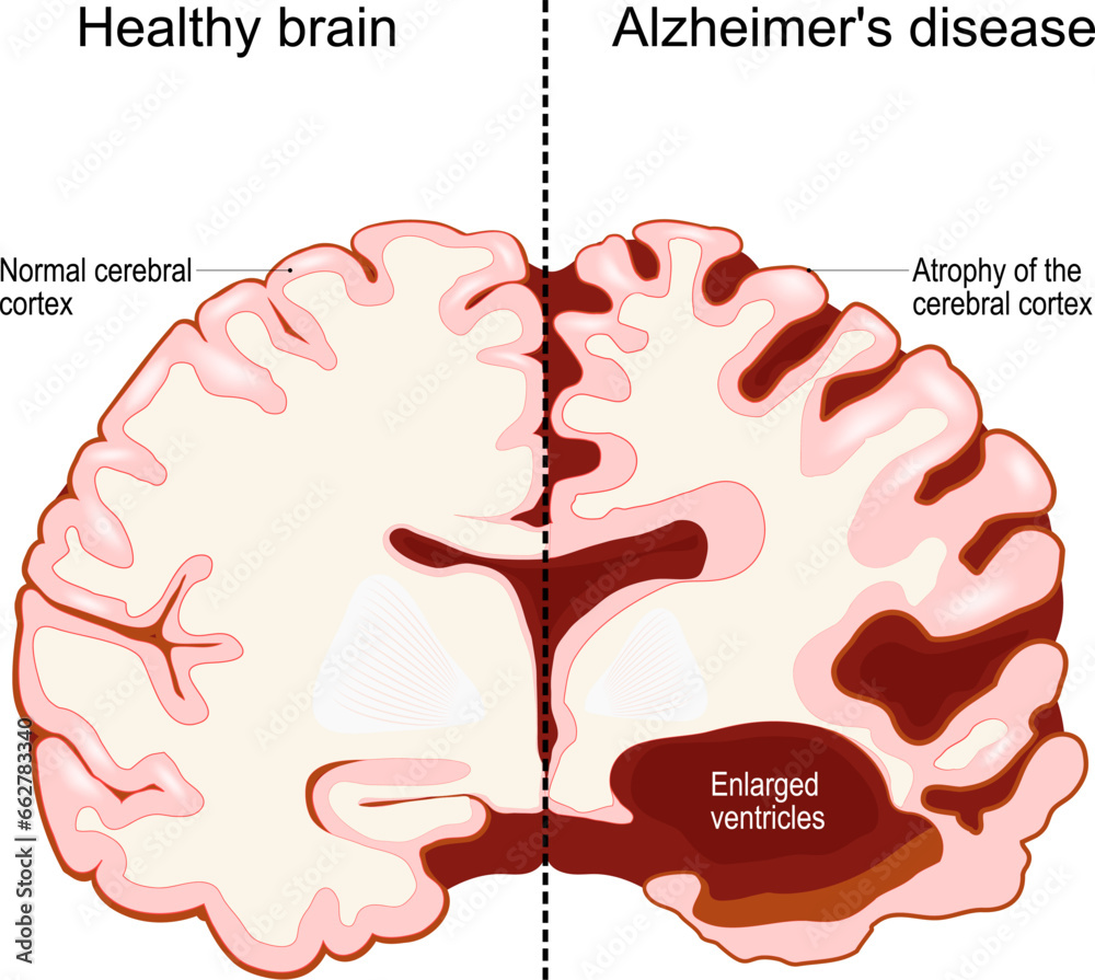 healthy brain and Alzheimer's disease. Neurodegenerative disorder. Dementia. - obrazy, fototapety, plakaty 