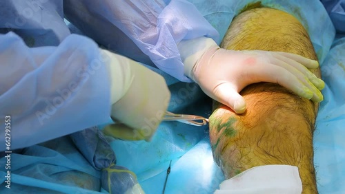 Medical surgery for endovenous laser photocoagulation of the great saphenous vein. Miniphlegectomy. Endovenous laser coagulation vein.