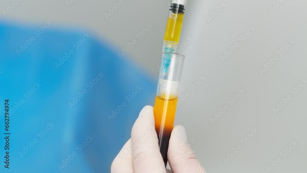 Doctor cosmetologist draws blood plasma into a syringe for the plasmolifting procedure, hands in gloves closeup. PRP therapy treatment in beauty clinic. Cure of problem skin.