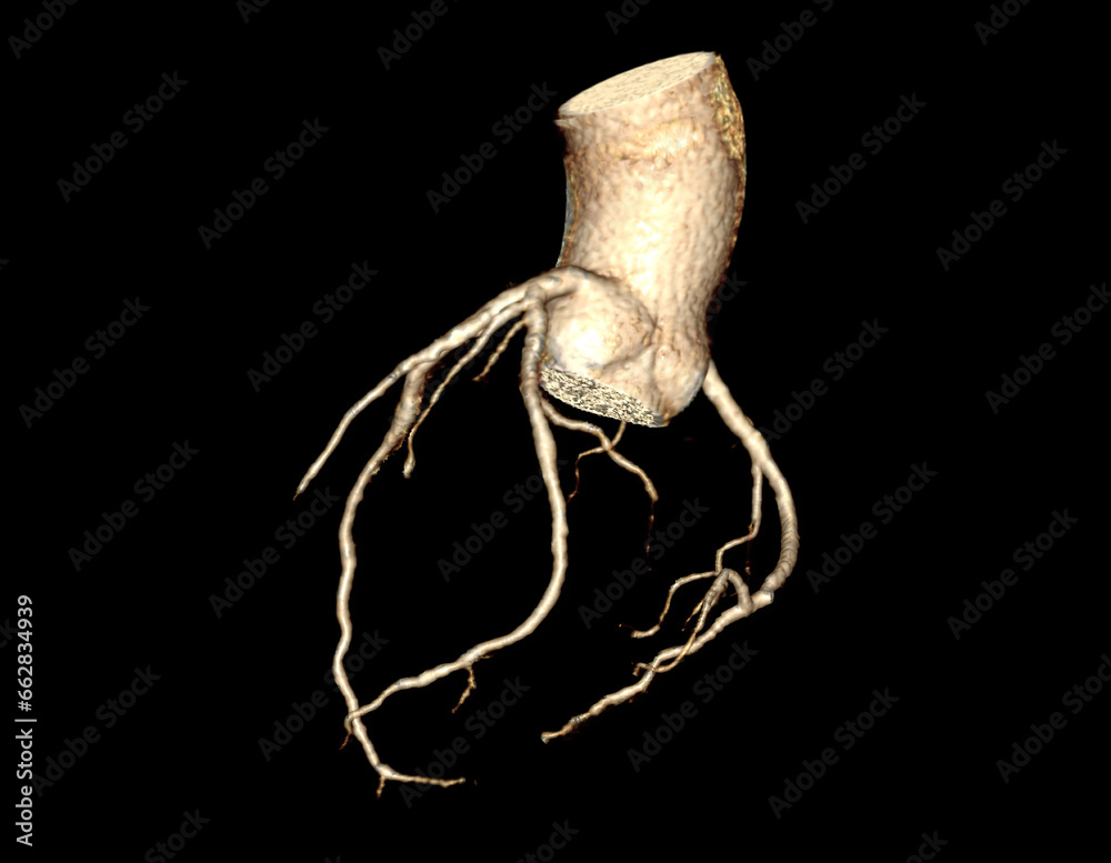 CTA Coronary artery 3D rendering image. CT angiographphy for heart ...