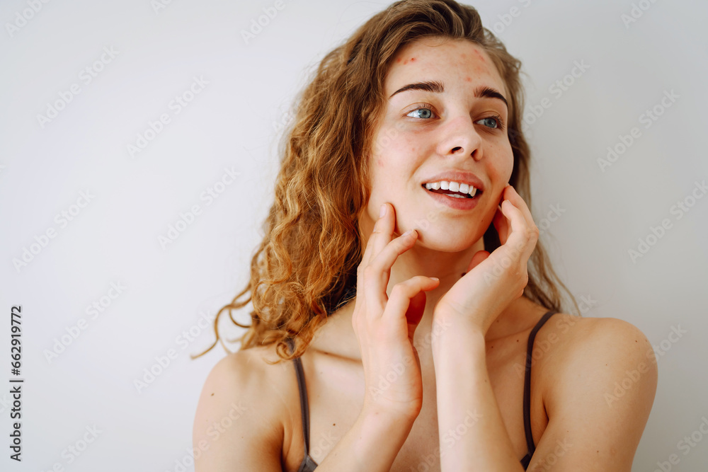 Close-up of a smiling woman with acne and rashes on her face. Medicine and cosmetology. Copy space. Close-up of a smiling woman with acne and rashes on her face. Medicine and cosmetology. Copy space.