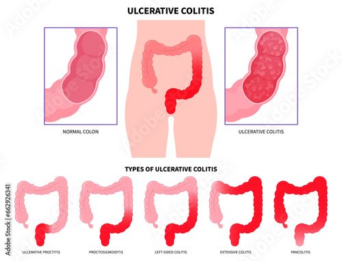 Constipation anatomy of large intestines inflammation with ulcerative colitis and Crohn's disease that has ulcer painful or diarrhea photo