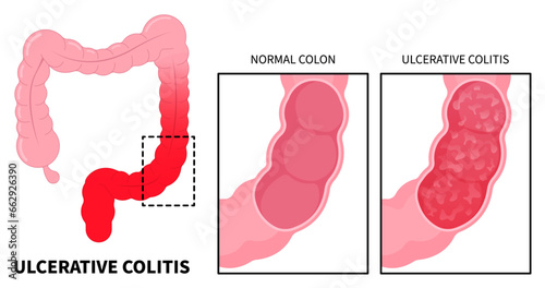 Anatomy of large intestines inflammation with ulcerative colitis and Crohn's disease that has ulcer painful or diarrhea photo