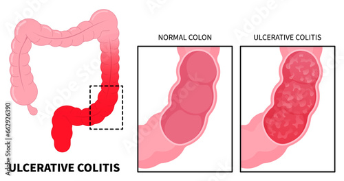 Anatomy of large intestines inflammation with ulcerative colitis and Crohn's disease that has ulcer painful or diarrhea