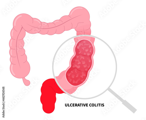 Chronic digestive colon inflammation of Ulcerative colitis and Crohn's disease with ulcer painful diarrhea photo