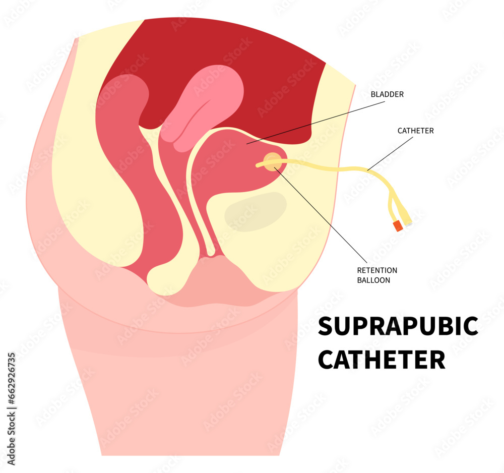 Bladder catheter to drain urine from urinary for the E coli bacteria