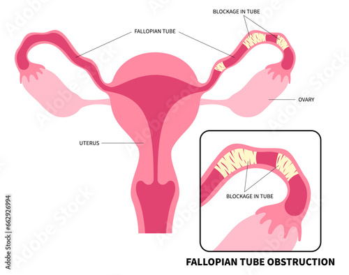 Uterine and female reproductive system with IVF or in vitro fertilization cause menstruation or ovaries painful