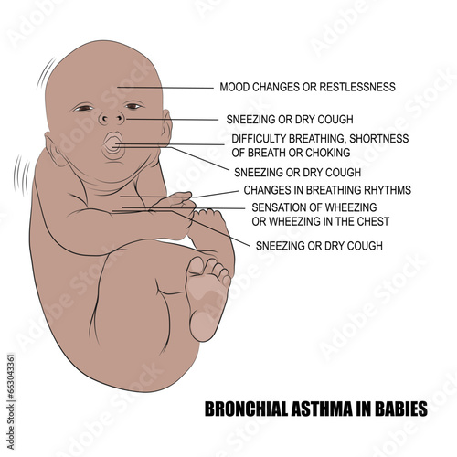 Asma bronquial en bebés, Tos frecuente que empeora cuando tu hijo tiene una infección viral.