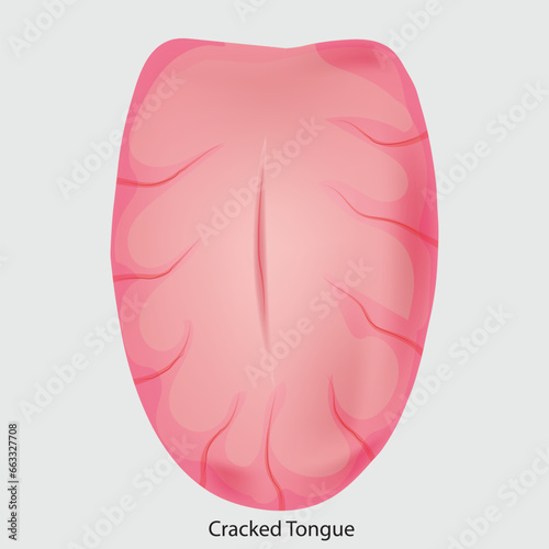 Disease of the tongue, cracks. medical illustration, health sign vector,  Man or Woman, isolated white, icon sheet,  horizontal, image with copy space, exclude people 