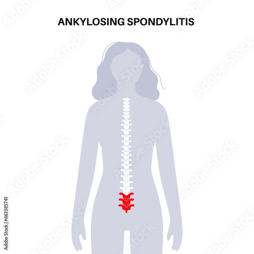 Ankylosing spondylitis disease photo