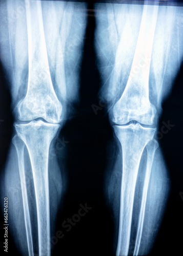 Plain X ray of both knee joints shows apparent joint osteoarthritis according to Kellgren and Lawrence system for classification of osteoarthritis with definite osteophytes and joint space narrowing photo