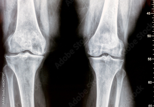 Plain X ray of both knee joints shows apparent joint osteoarthritis according to Kellgren and Lawrence system for classification of osteoarthritis with definite osteophytes and joint space narrowing photo