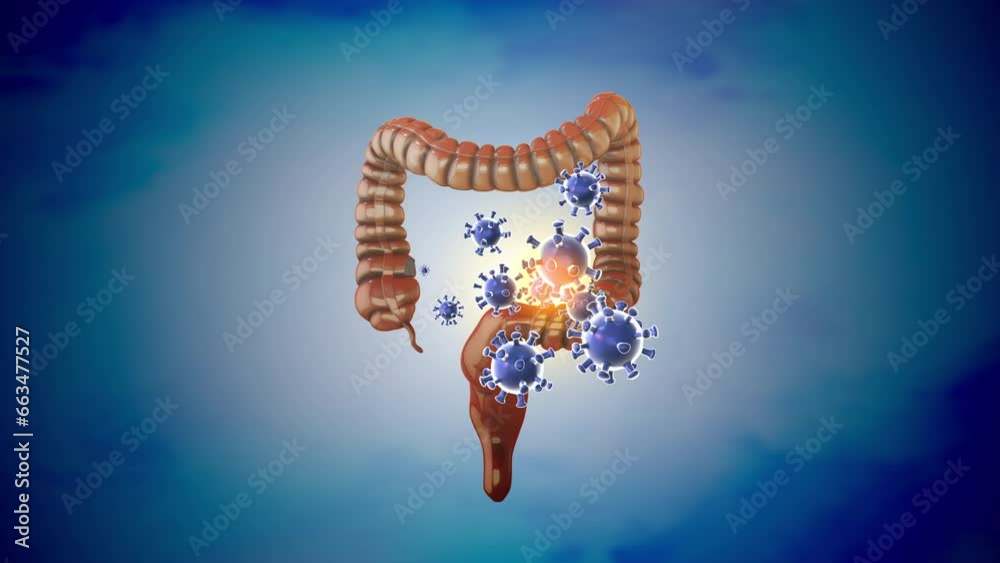 Medical concept of a large intestinal infection