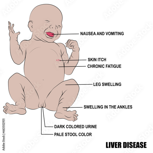 Liver disease in a baby, symptoms of the disease.