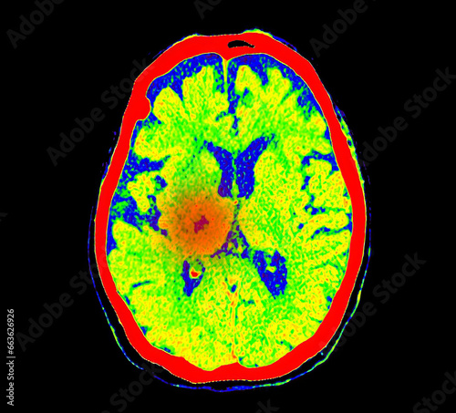 CT Brain Perfusion or CT scan image of the brain axial view  showing  cerebral blood flow on the monitor at stroke area.