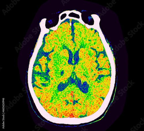 CT Brain Perfusion or CT scan image of the brain axial view  showing  cerebral blood flow on the monitor at stroke area.