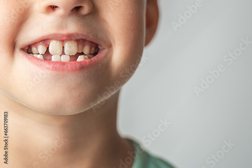 The child shows baby teeth. Pediatric dentistry and periodontology, bite correction. Close-up