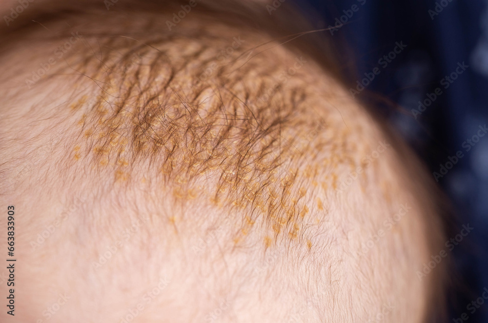 Milk crusts on the head of a newborn child, gneiss. The formation of yellow-golden scales on the head of an infant, close-up Milk crusts on the head of a newborn child, gneiss. The formation of yellow-golden scales on the head of an infant, close-up
