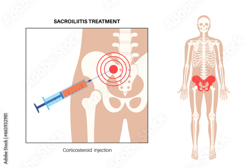 Sacroiliitis corticosteroid injections