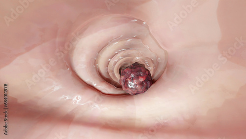 Colorectal cancer, malignant tumor in intestine, Endoscope inside colonoscopy, gut intestine, Colon polyp removal, colonic polyps search, Polypectomy, intestinal carcinoma, bowel neoplasia, 3d render photo