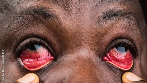 Eyes section of a face showing infectious, unhealthy, and abnormal redness of the eye which is caused by a communicable disease called conjunctivitis health condition, also known as Apollo in Nigeria, photo