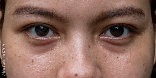 Black spots, moles and scars around the eyes of Asian woman. photo