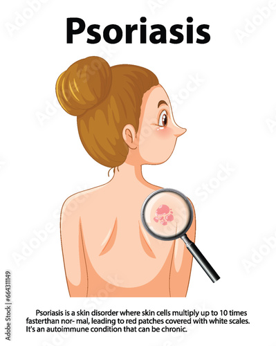 Women with Psoriasis: Understanding the Skin Disease