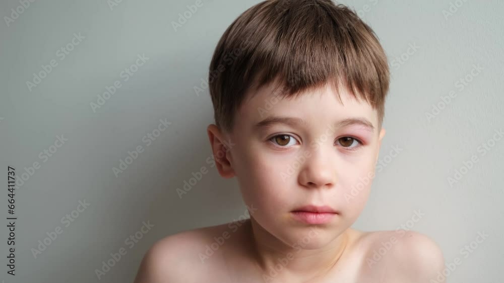 The boy looking at the camera with a swollen eye from an insect bite