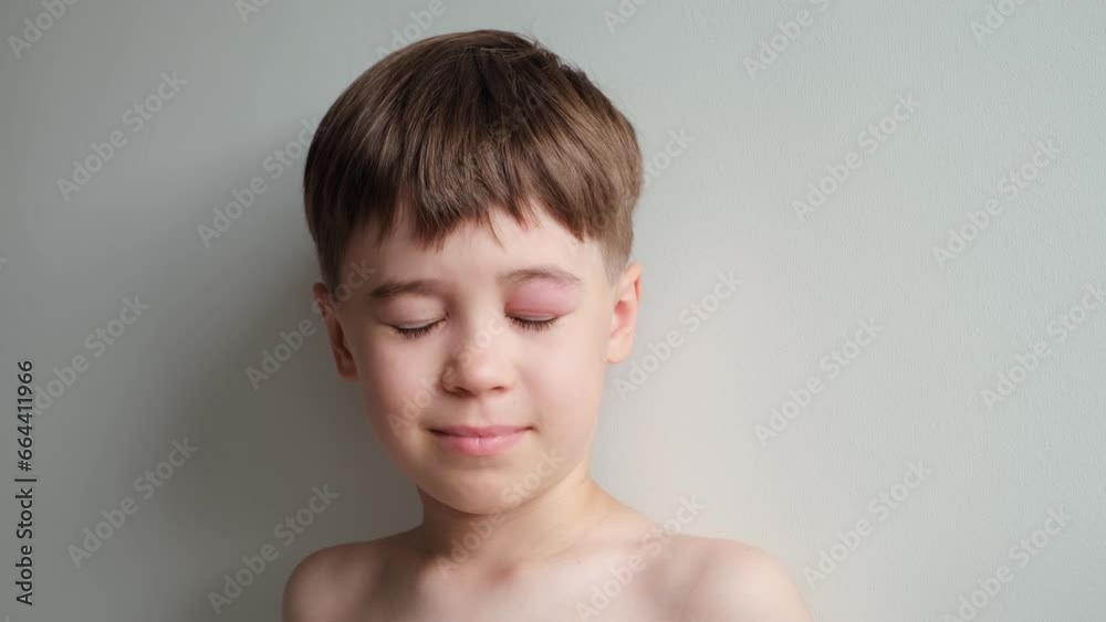 Vidéo Stock The boy looking at the camera with a swollen eye from an