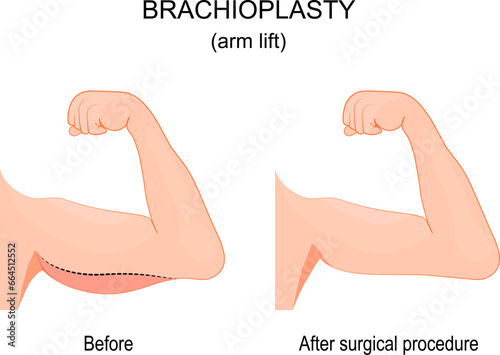 Brachioplasty. Before and after surgical procedure.