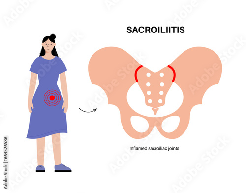 Sacroiliitis medical poster