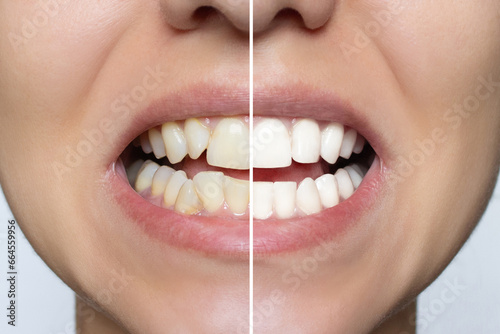 Young woman's smile before and after teeth straightening. Ideal, beautiful shape of teeth on the upper and lower jaw after installing veneers or braces. Bleaching. Dental clinic patient. Whitening. photo