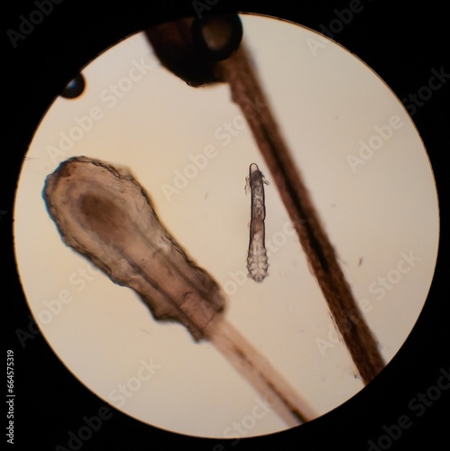 Demodex folliculorum - parasitic mite on the eyelashes of a human eye photo