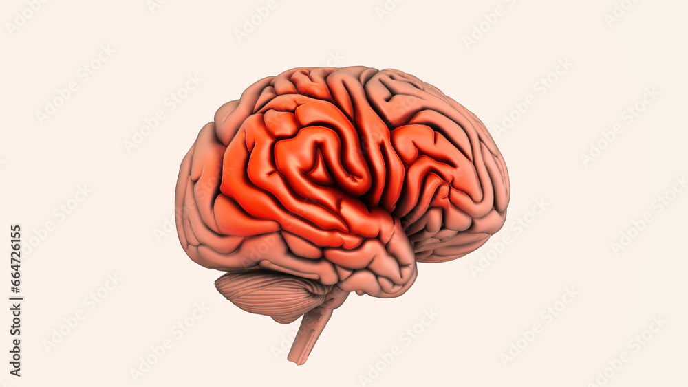 The cause of hemorrhagic stroke is brain hemorrhage The cause of hemorrhagic stroke is brain hemorrhage
