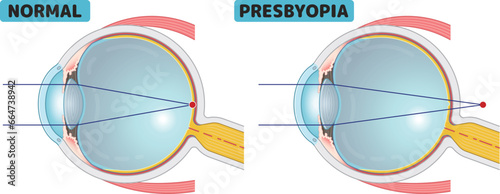 近視、遠視、老眼、乱視、myopia、hyperopia、presbyopia、astigmatism・eye・illustration