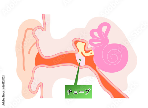 鼓膜にチューブが刺さっている状態のシンプルなイラスト photo