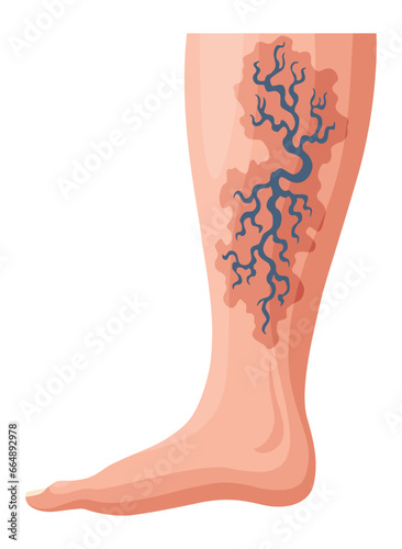 Stages or types of varicose veins development. Medical poster or disease infographic. Image of diseased legs. Vector illustration in flat style