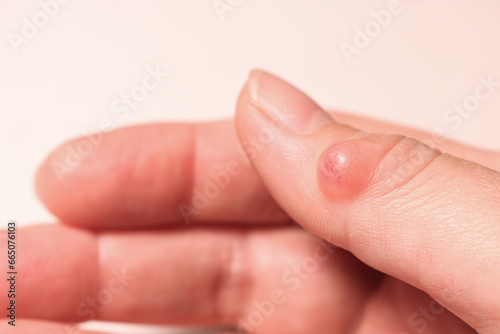 Female hand with hygroma of the thumb. Selective focus.