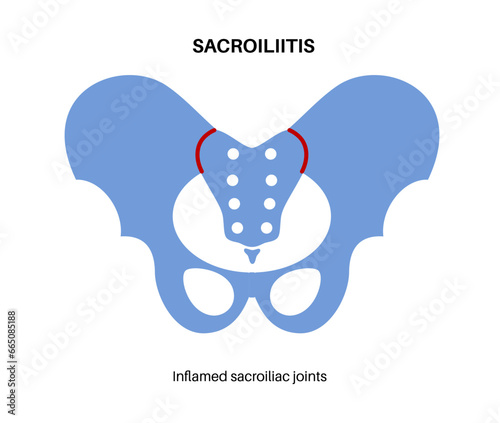Sacroiliitis medical poster