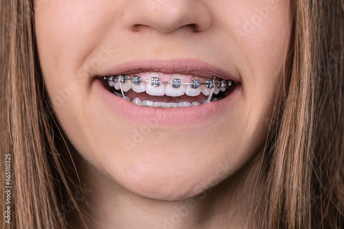  Girl teeth  with braces and elastic rubber. Orthodontist treatment.